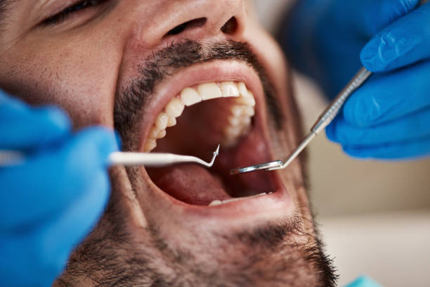 Best Emergency Dentist for Lost Fillings or Crowns in Belton, SC