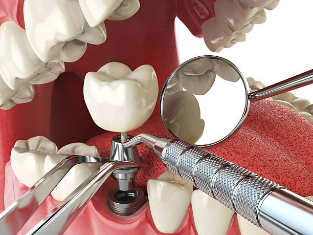 Best Broken or Cracked Tooth Emergency Dentist in Belton, SC